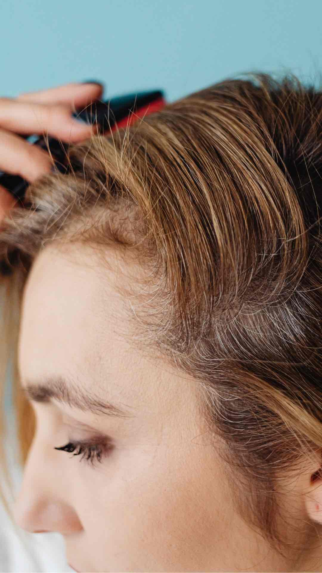 Rambut Kamu Tipis Sampai Kulit Kepala Terlihat? Ini Solusinya