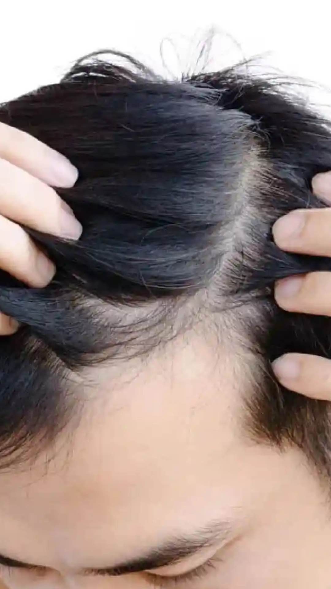Rambut Menipis Bagian Depan Ini Solusinya