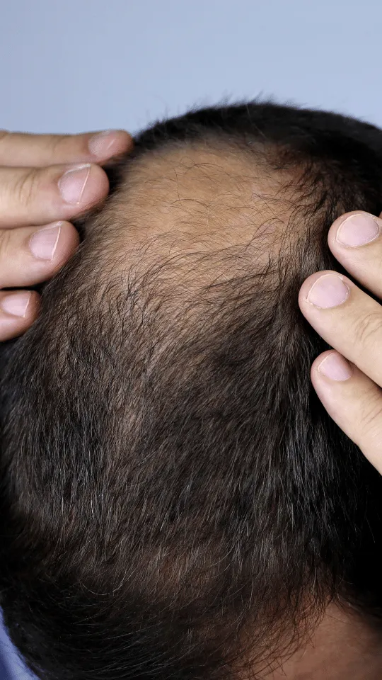 Rambut Tipis Tanda Kebotakan Cek Faktanya